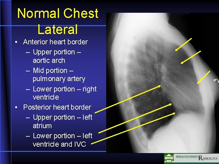 Normal Chest Lateral • Anterior heart border – Upper portion – aortic arch –