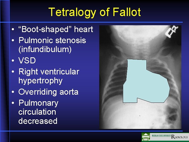 Tetralogy of Fallot • “Boot-shaped” heart • Pulmonic stenosis (infundibulum) • VSD • Right