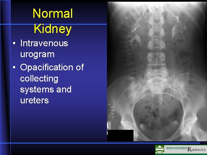 Normal Kidney • Intravenous urogram • Opacification of collecting systems and ureters Normal Kidney • Intravenous urogram • Opacification of collecting systems and ureters