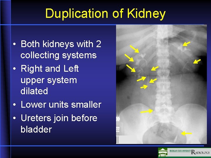 Duplication of Kidney • Both kidneys with 2 collecting systems • Right and Left Duplication of Kidney • Both kidneys with 2 collecting systems • Right and Left