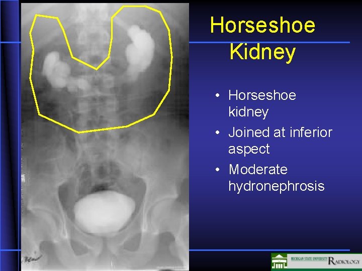 Horseshoe Kidney • Horseshoe kidney • Joined at inferior aspect • Moderate hydronephrosis 