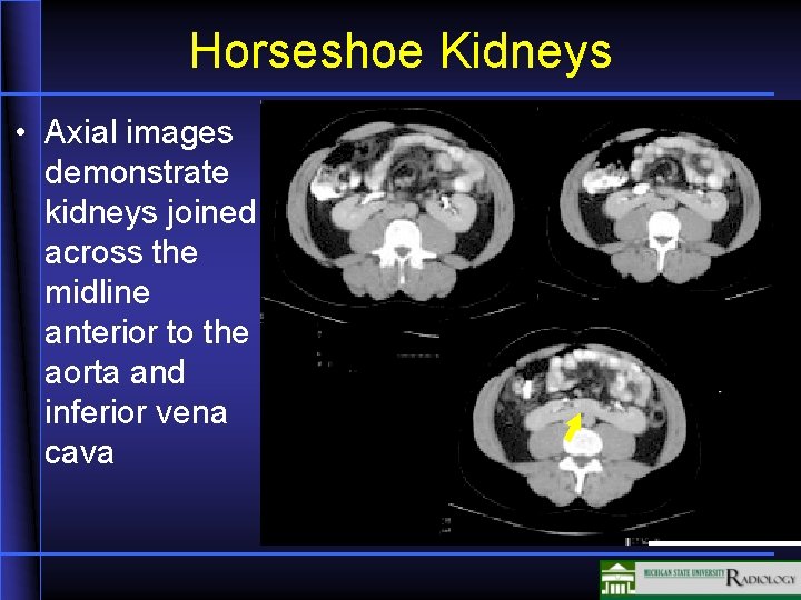 Horseshoe Kidneys • Axial images demonstrate kidneys joined across the midline anterior to the