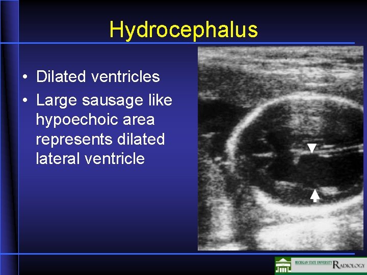 Hydrocephalus • Dilated ventricles • Large sausage like hypoechoic area represents dilated lateral ventricle