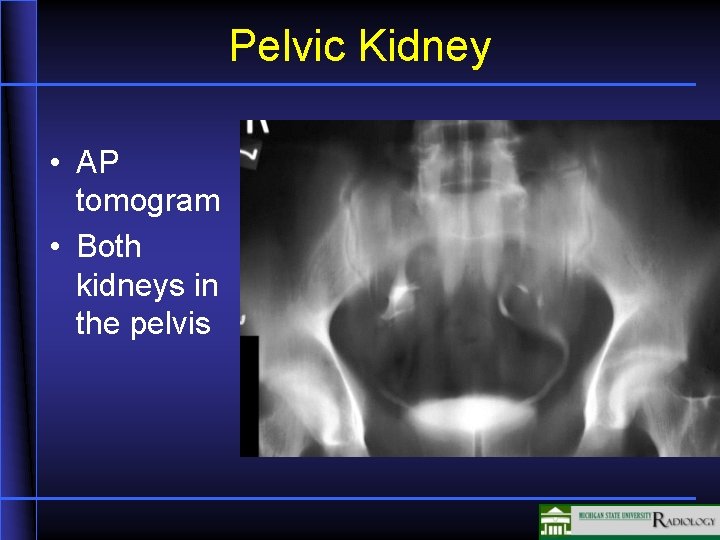 Pelvic Kidney • AP tomogram • Both kidneys in the pelvis 