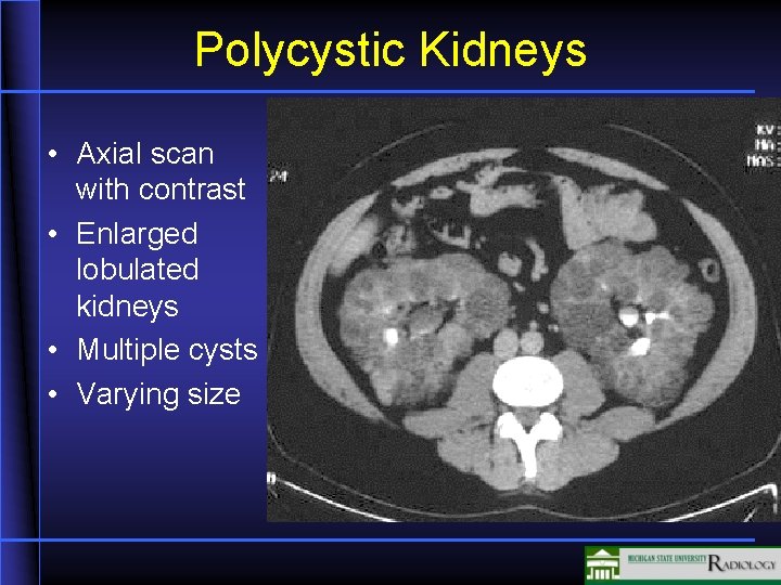 Polycystic Kidneys • Axial scan with contrast • Enlarged lobulated kidneys • Multiple cysts Polycystic Kidneys • Axial scan with contrast • Enlarged lobulated kidneys • Multiple cysts