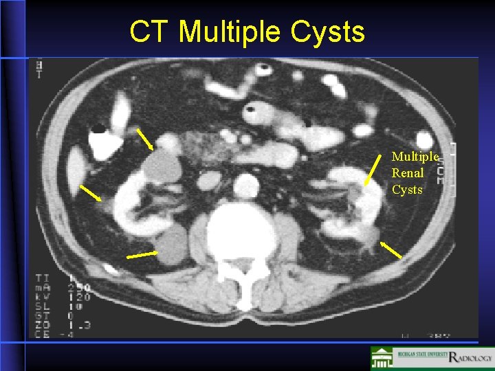 CT Multiple Cysts Multiple Renal Cysts 