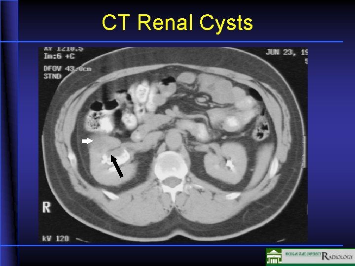 CT Renal Cysts 