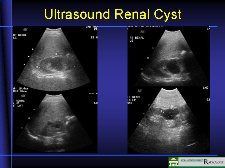 Ultrasound Renal Cyst 