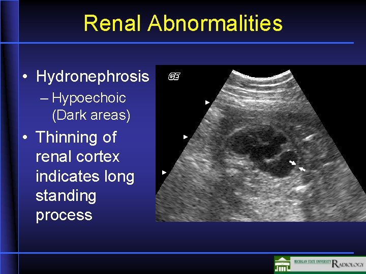 Renal Abnormalities • Hydronephrosis – Hypoechoic (Dark areas) • Thinning of renal cortex indicates