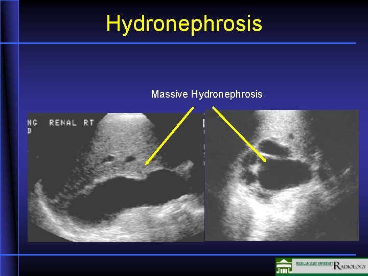 Hydronephrosis Massive Hydronephrosis 