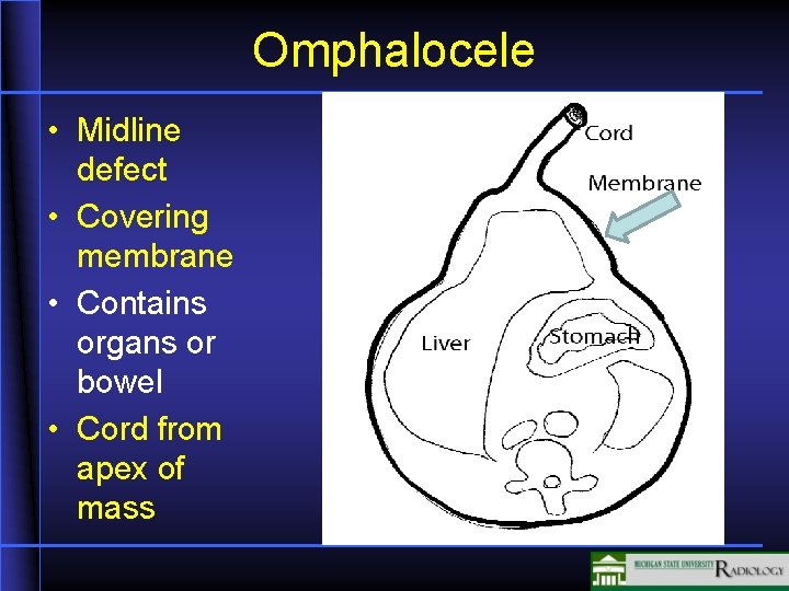 Omphalocele • Midline defect • Covering membrane • Contains organs or bowel • Cord