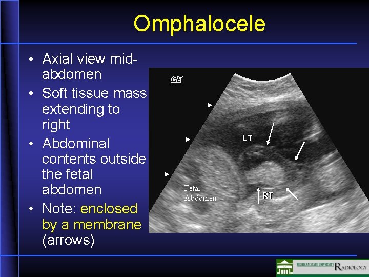 Omphalocele • Axial view midabdomen • Soft tissue mass extending to right • Abdominal