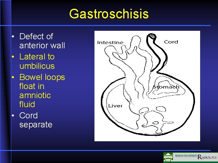 Gastroschisis • Defect of anterior wall • Lateral to umbilicus • Bowel loops float