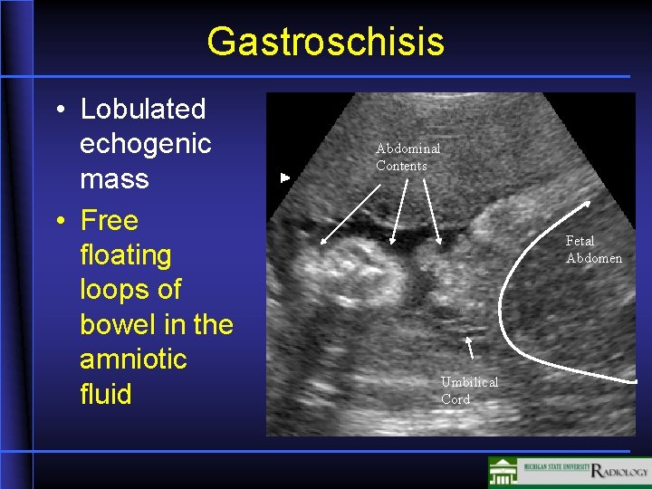 Gastroschisis • Lobulated echogenic mass • Free floating loops of bowel in the amniotic