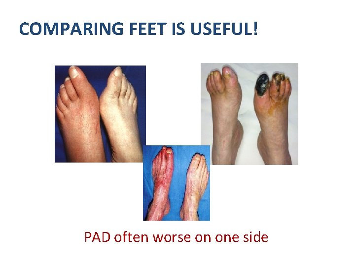 COMPARING FEET IS USEFUL! PAD often worse on one side 