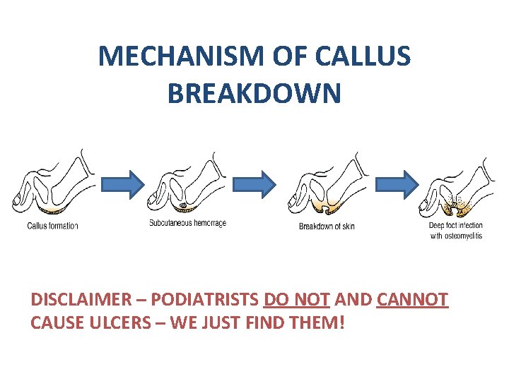 MECHANISM OF CALLUS BREAKDOWN DISCLAIMER – PODIATRISTS DO NOT AND CANNOT CAUSE ULCERS –