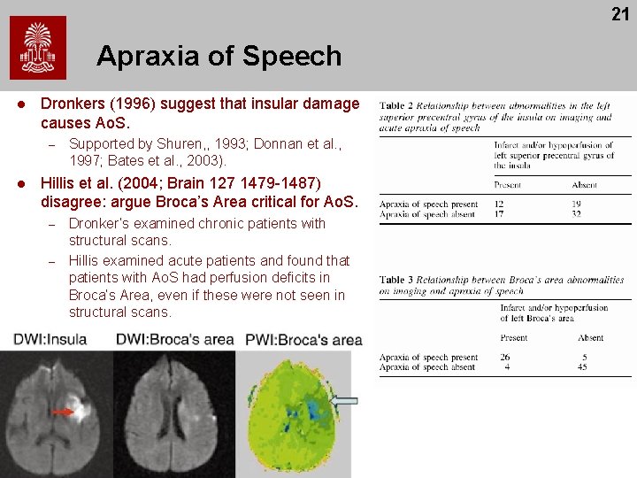 21 Apraxia of Speech l Dronkers (1996) suggest that insular damage causes Ao. S. 21 Apraxia of Speech l Dronkers (1996) suggest that insular damage causes Ao. S.