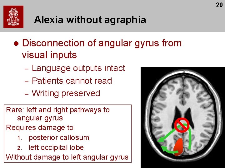 29 Alexia without agraphia l Disconnection of angular gyrus from visual inputs – – 29 Alexia without agraphia l Disconnection of angular gyrus from visual inputs – –