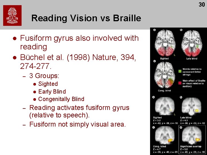 30 Reading Vision vs Braille l l Fusiform gyrus also involved with reading Büchel 30 Reading Vision vs Braille l l Fusiform gyrus also involved with reading Büchel