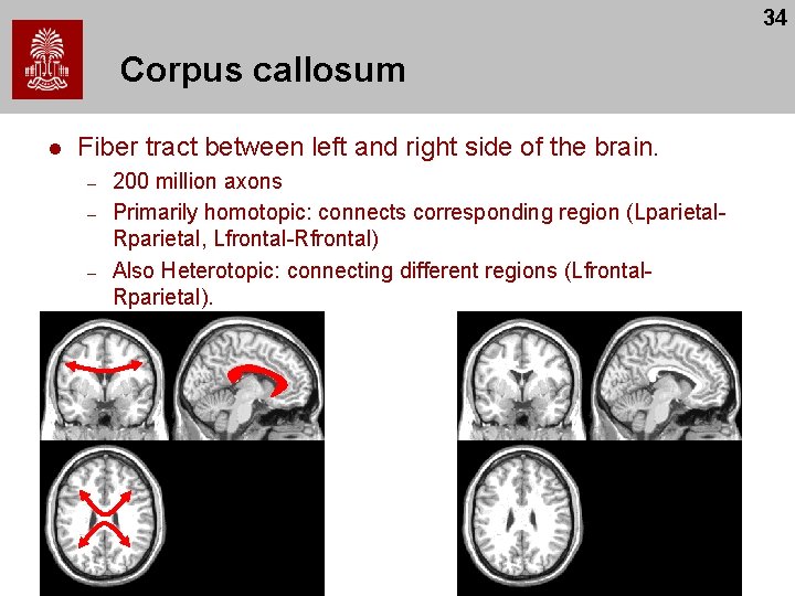 34 Corpus callosum l Fiber tract between left and right side of the brain. 34 Corpus callosum l Fiber tract between left and right side of the brain.