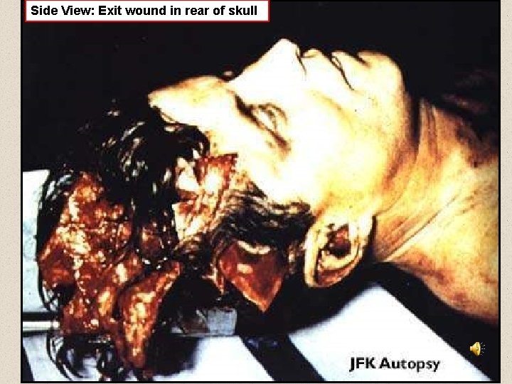 Side View: Exit wound in rear of skull 