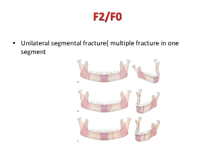 F 2/F 0 • Unilateral segmental fracture( multiple fracture in one segment 