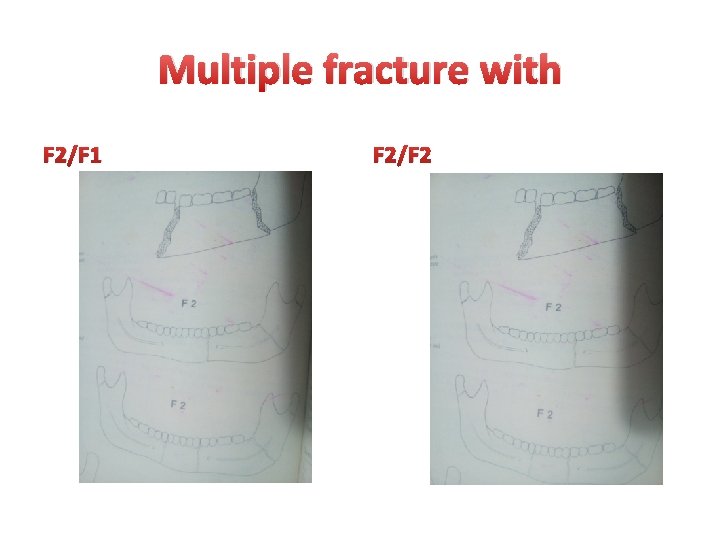 Multiple fracture with F 2/F 1 F 2/F 2 Multiple fracture with F 2/F 1 F 2/F 2