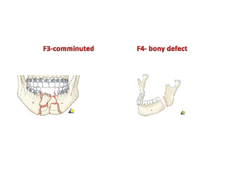 F 3 -comminuted F 4 - bony defect 