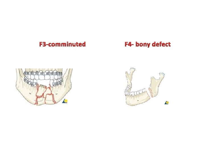 F 3 -comminuted F 4 - bony defect F 3 -comminuted F 4 - bony defect