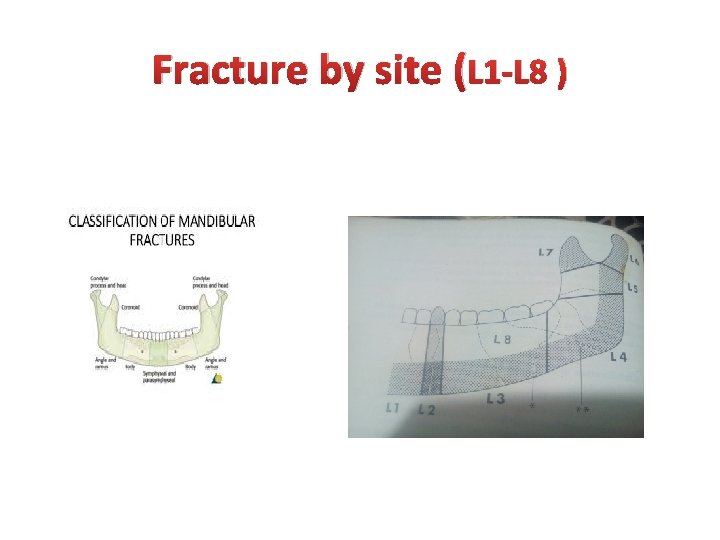 Fracture by site (L 1 -L 8 ) Fracture by site (L 1 -L 8 )