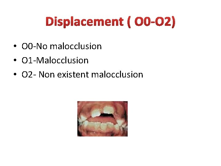 Displacement ( O 0 -O 2) • O 0 -No malocclusion • O 1 Displacement ( O 0 -O 2) • O 0 -No malocclusion • O 1