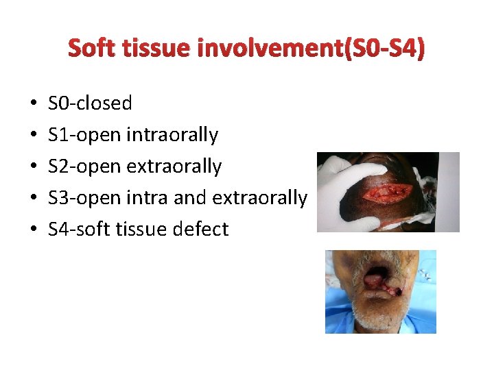 Soft tissue involvement(S 0 -S 4) • • • S 0 -closed S 1