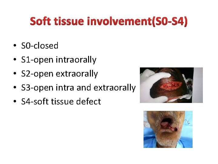 Soft tissue involvement(S 0 -S 4) • • • S 0 -closed S 1 Soft tissue involvement(S 0 -S 4) • • • S 0 -closed S 1