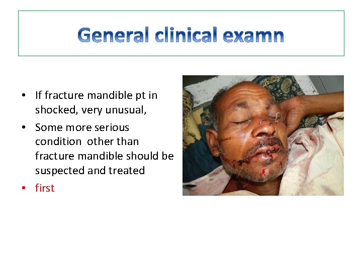  • If fracture mandible pt in shocked, very unusual, • Some more serious