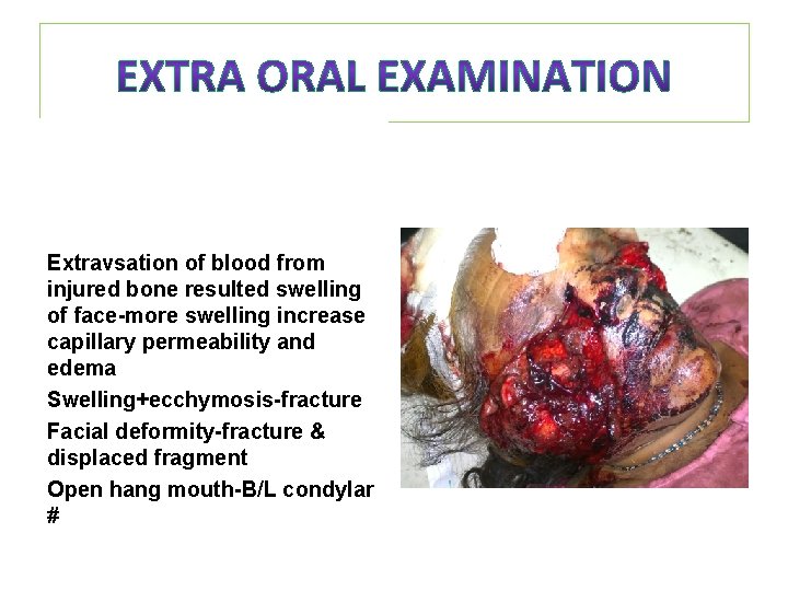 Extravsation of blood from injured bone resulted swelling of face-more swelling increase capillary permeability