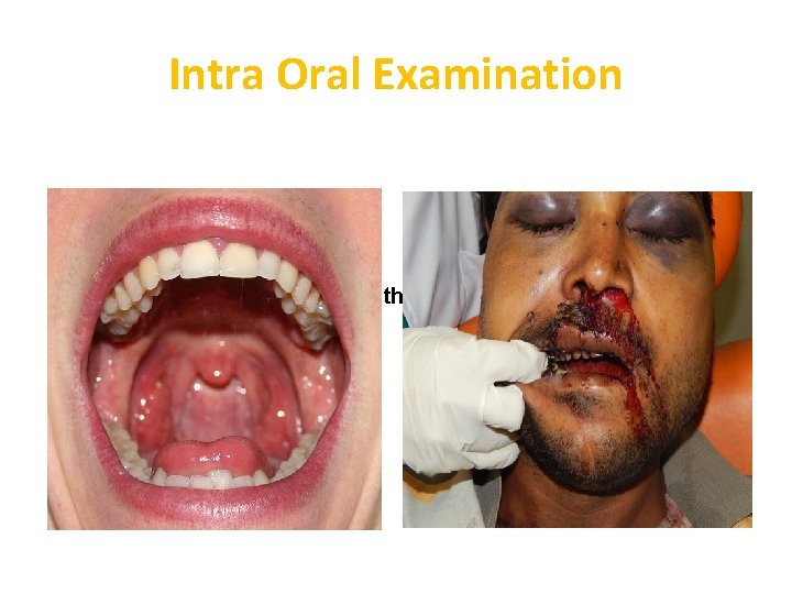 Intra Oral Examination Clean oral cavity-lukewarm mouth wash/ cleaned with moistened swab Congealed blood, Intra Oral Examination Clean oral cavity-lukewarm mouth wash/ cleaned with moistened swab Congealed blood,