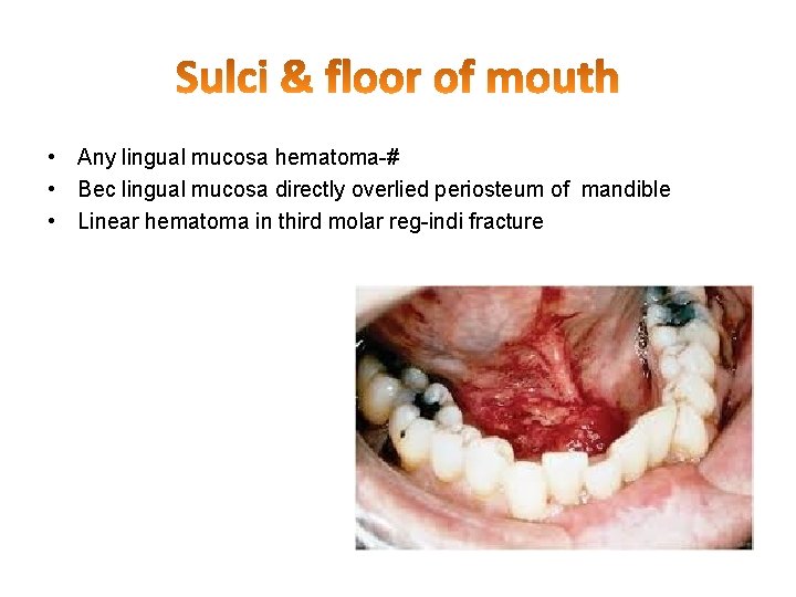 • Any lingual mucosa hematoma-# • Bec lingual mucosa directly overlied periosteum of • Any lingual mucosa hematoma-# • Bec lingual mucosa directly overlied periosteum of