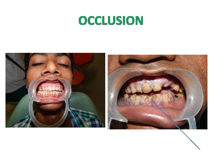 OCCLUSION OCCLUSION