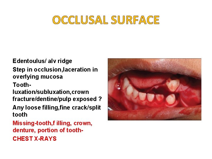OCCLUSAL SURFACE Edentoulus/ alv ridge Step in occlusion, laceration in overlying mucosa Toothluxation/subluxation, crown