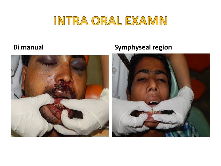 INTRA ORAL EXAMN Bi manual Symphyseal region INTRA ORAL EXAMN Bi manual Symphyseal region