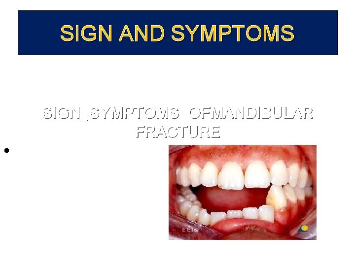 SIGN AND SYMPTOMS • SIGN , SYMPTOMS OFMANDIBULAR FRACTURE 