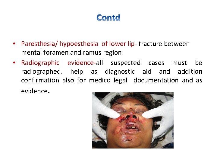  • Paresthesia/ hypoesthesia of lower lip- fracture between mental foramen and ramus region