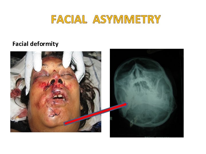 FACIAL ASYMMETRY Facial deformity 