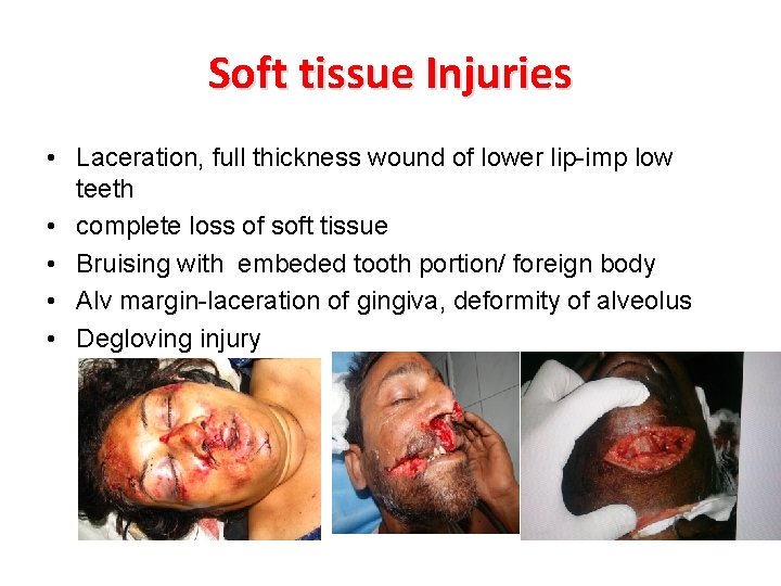 Soft tissue Injuries • Laceration, full thickness wound of lower lip-imp low teeth • Soft tissue Injuries • Laceration, full thickness wound of lower lip-imp low teeth •