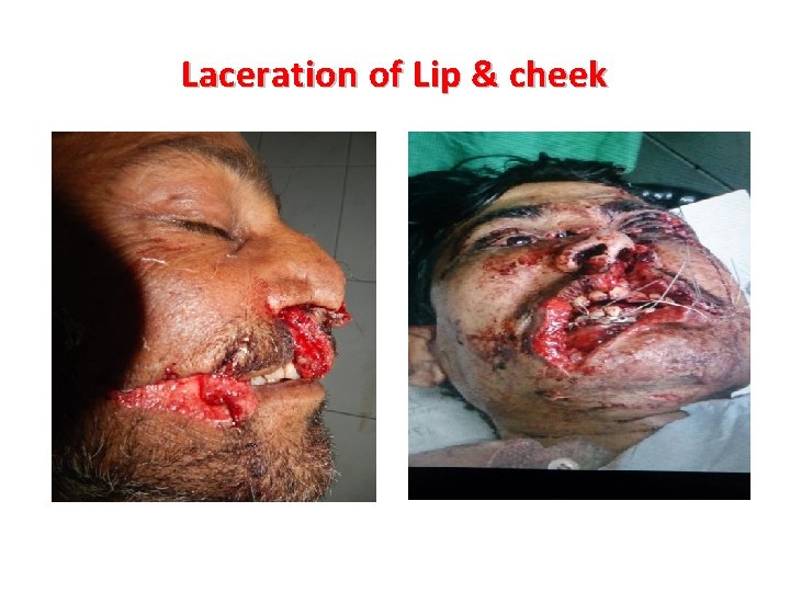 Laceration of Lip & cheek Laceration of Lip & cheek