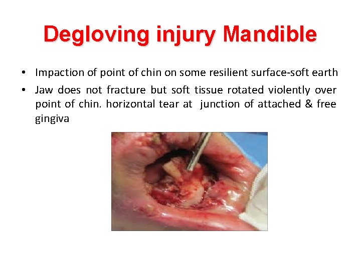 Degloving injury Mandible • Impaction of point of chin on some resilient surface-soft earth Degloving injury Mandible • Impaction of point of chin on some resilient surface-soft earth