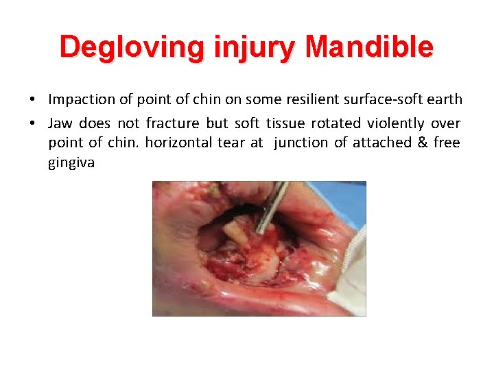 Degloving injury Mandible • Impaction of point of chin on some resilient surface-soft earth