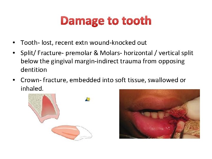 Damage to tooth • Tooth- lost, recent extn wound-knocked out • Split/ Fracture- premolar Damage to tooth • Tooth- lost, recent extn wound-knocked out • Split/ Fracture- premolar