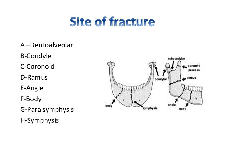 A –Dentoalveolar B-Condyle C-Coronoid D-Ramus E-Angle F-Body G-Para symphysis H-Symphysis 