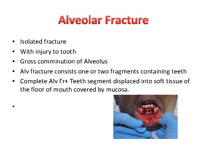 Alveolar Fracture • • • Isolated fracture With injury to tooth Gross comminution of